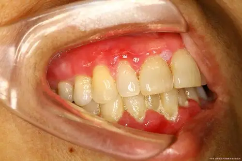 良性黏膜类天疱疮1例