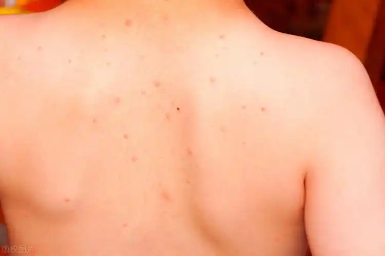 身体出现这两个症状,也要及时检查1, 腹泻当一个人感染艾滋病时,特别