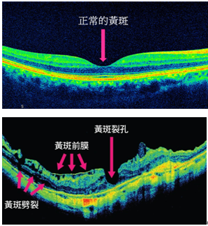 黄斑病变原因 深近视引起的黄斑病变
