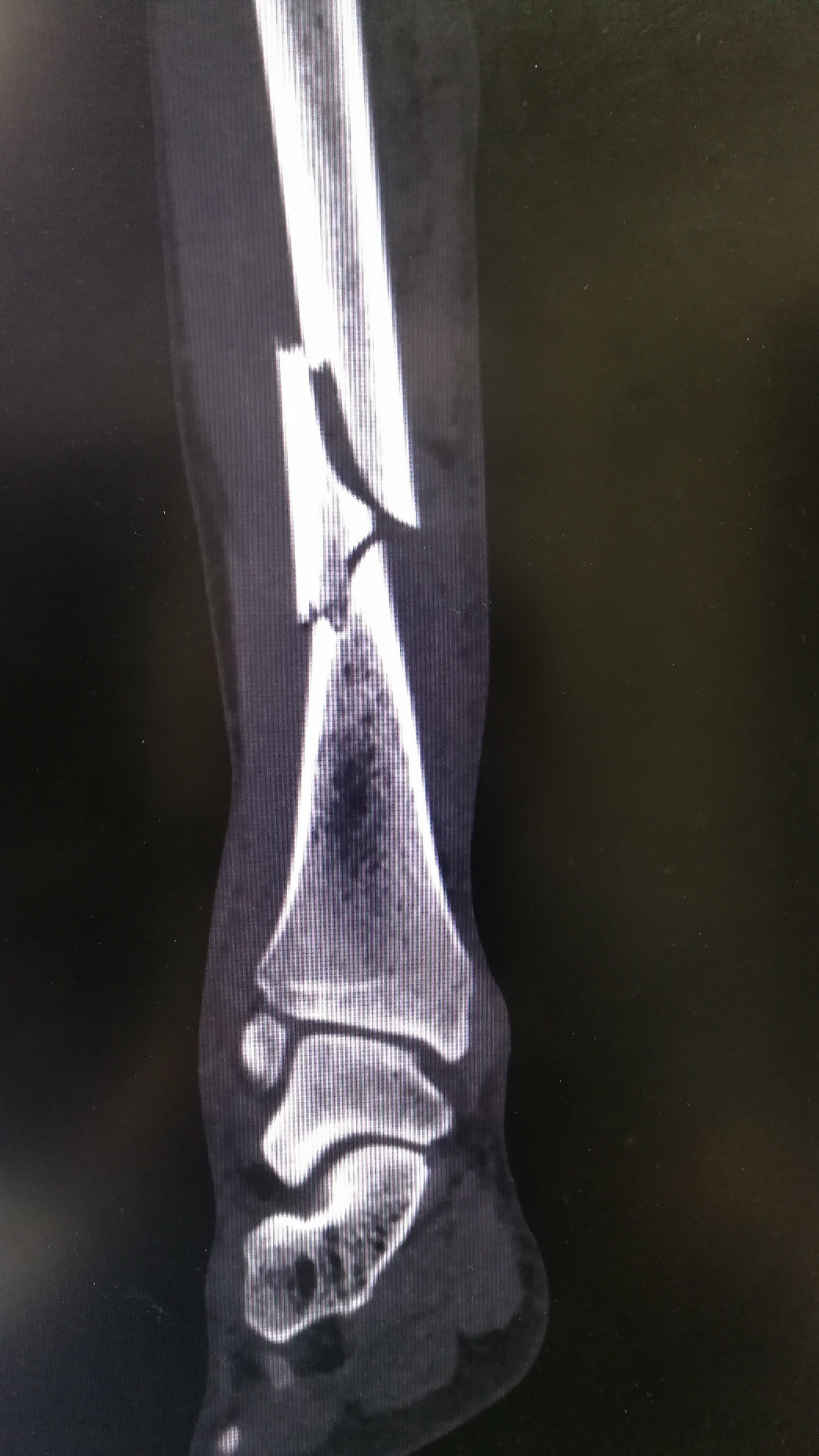 胫,腓骨骨折 - 好大夫在线