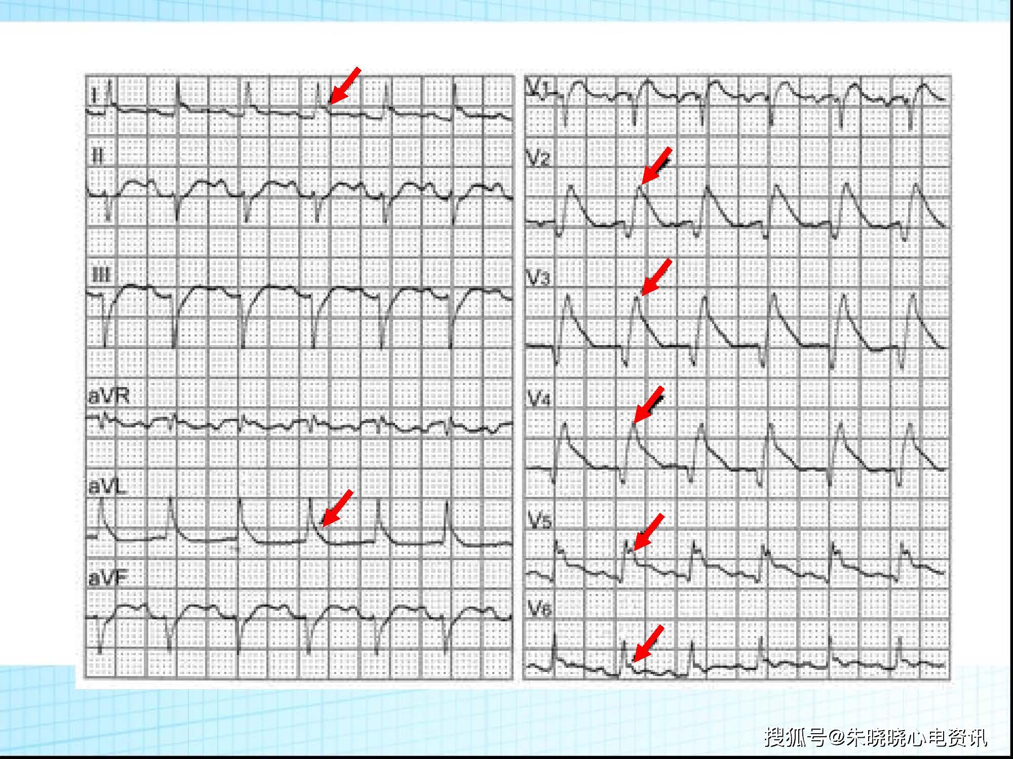 心电图背后的故事诡异的st段抬高
