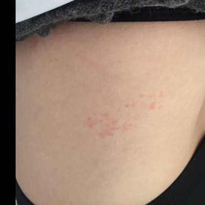 孕5个月了长带状疱疹怎麼办啊?在左腰上.