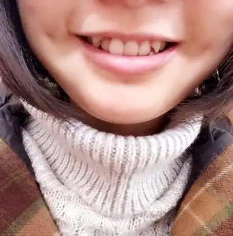 为什么别人家的虎牙长得那么好看,我的虎牙就长成这歪七扭八的狗样儿