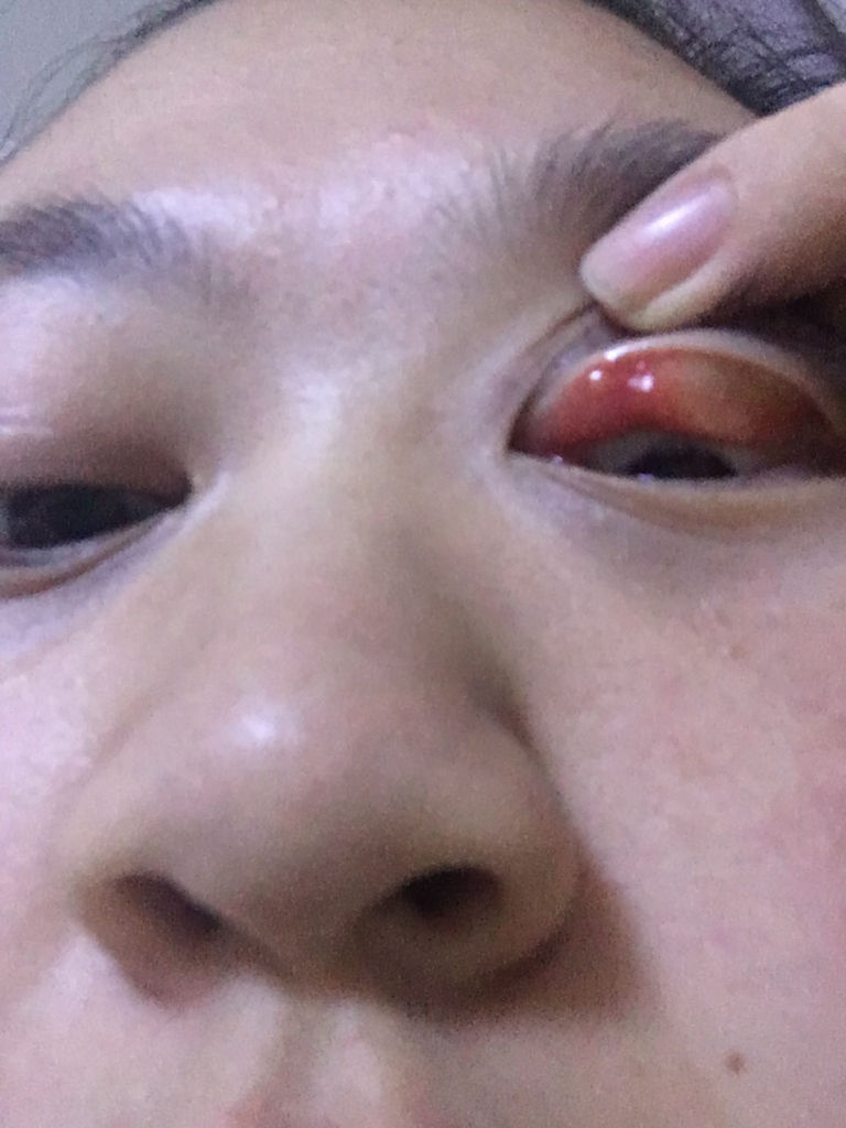 眼睛肿 起了这个东西 有没有眼科大夫帮我看一下这是什么?用什么药啊