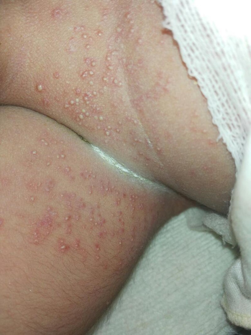 婴儿肛周湿疹图片_有来医生