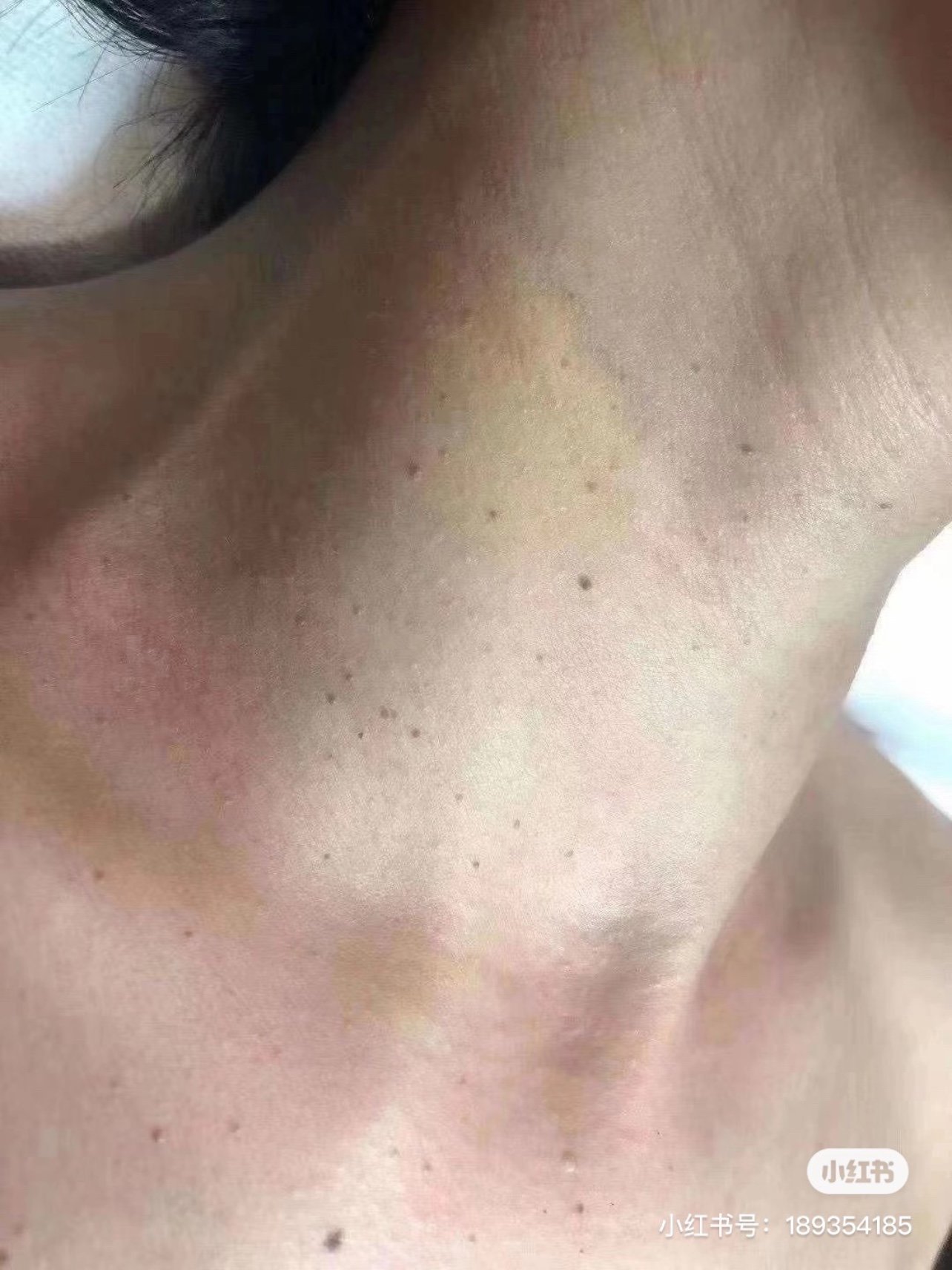 他能带来什么危害?你们是怎么祛除的?