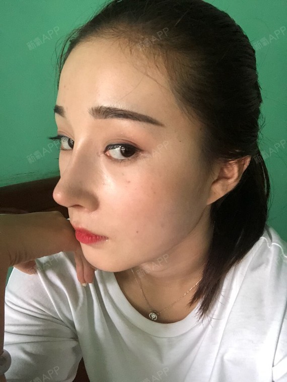 鼻子做失败了,膨体肋软骨.两个月了,我要去做修复!