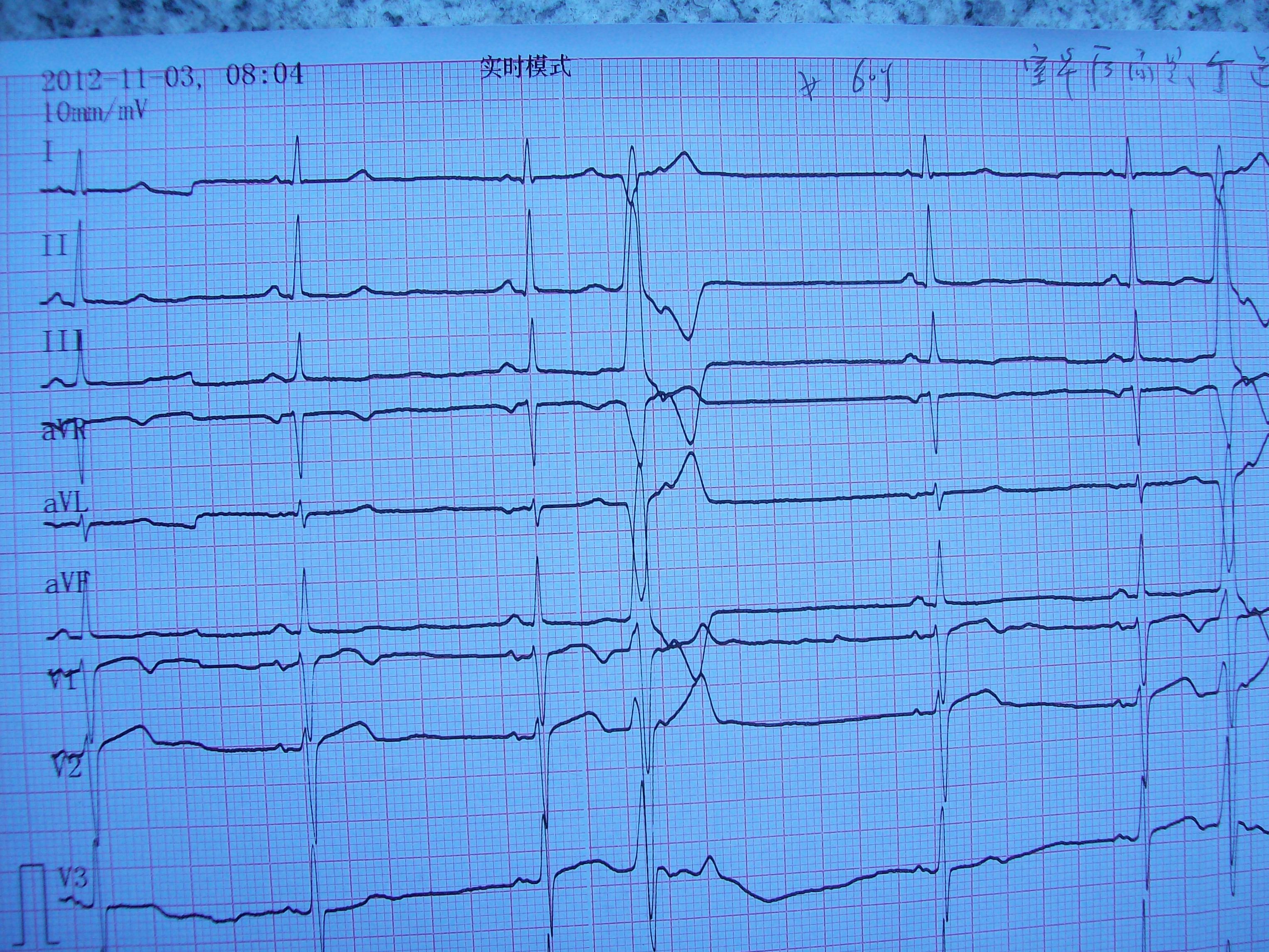室性早搏? 交界性早搏? - 心电图脑电图专业讨论版 - 爱爱医医学论坛
