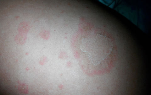 花斑癣图片花斑癣该怎么治疗会传染吗