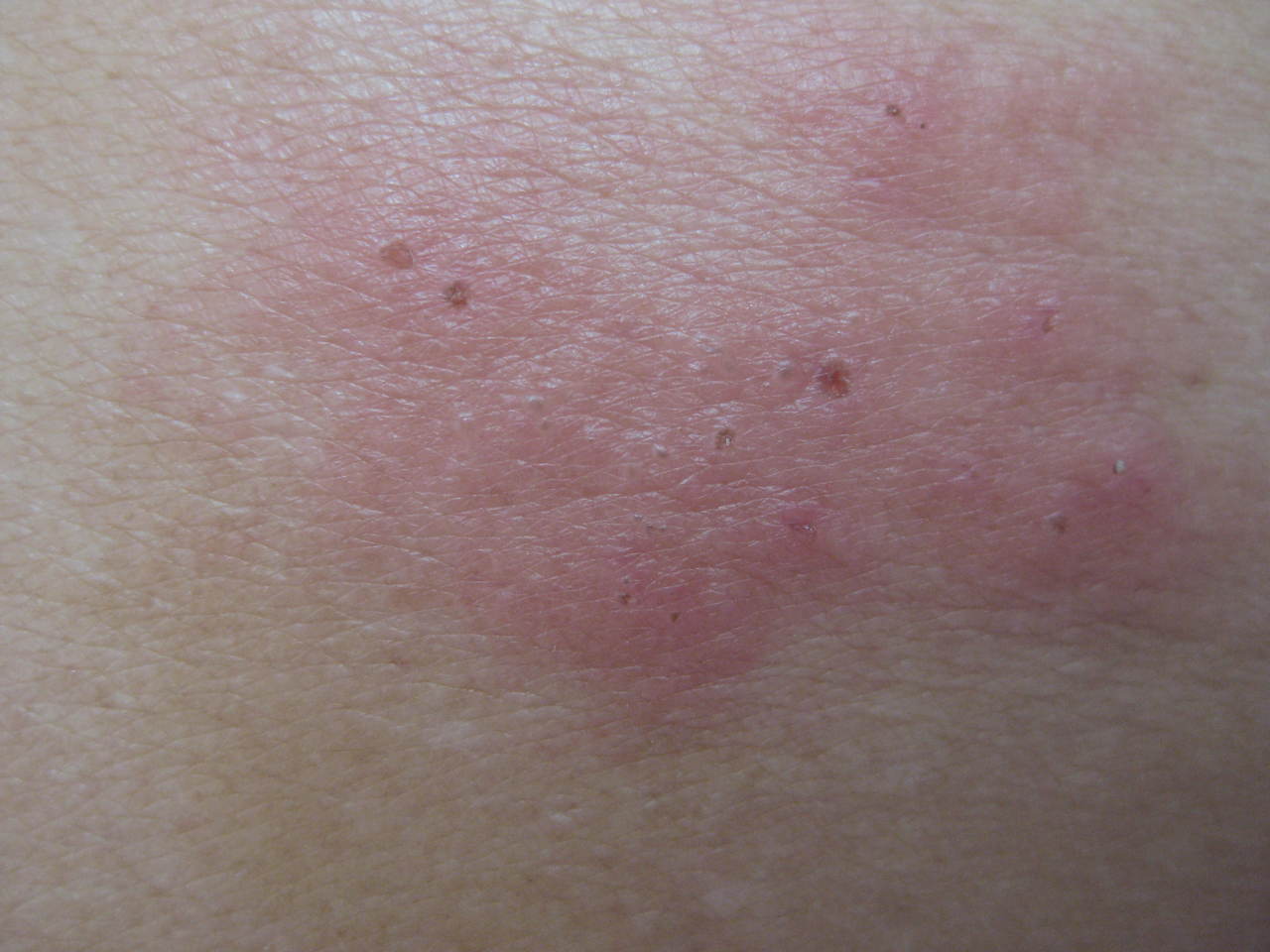 "后背出现红色疙瘩,疼"请哪位看看