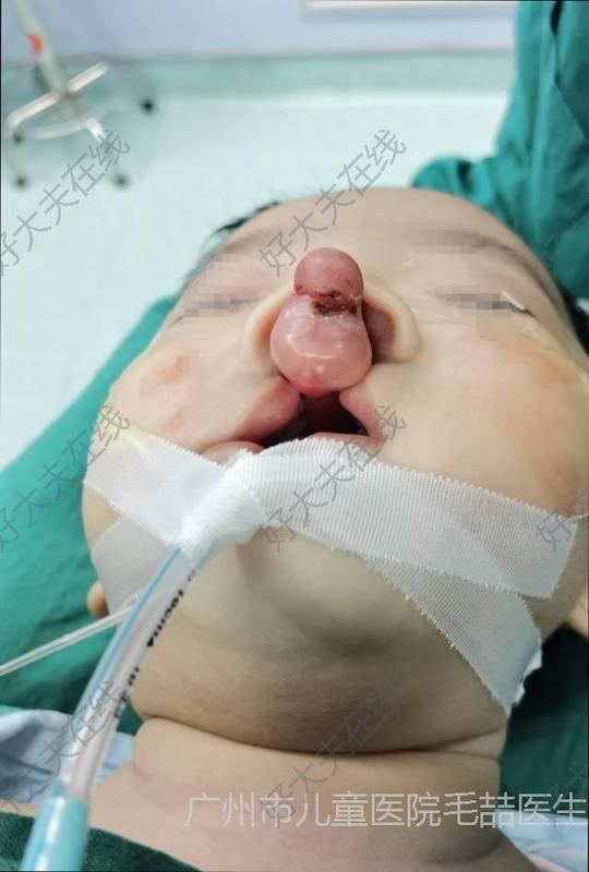 患者为严重的双侧完全性唇腭裂,前颌骨前突明显,唇部软组织不足,鼻翼