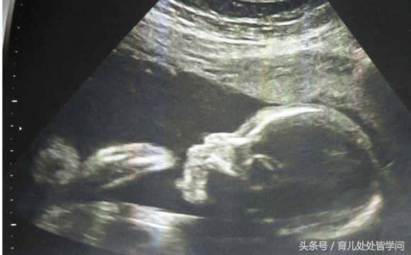 b超单子上有男女暗示吗?教你如何看胎儿性别