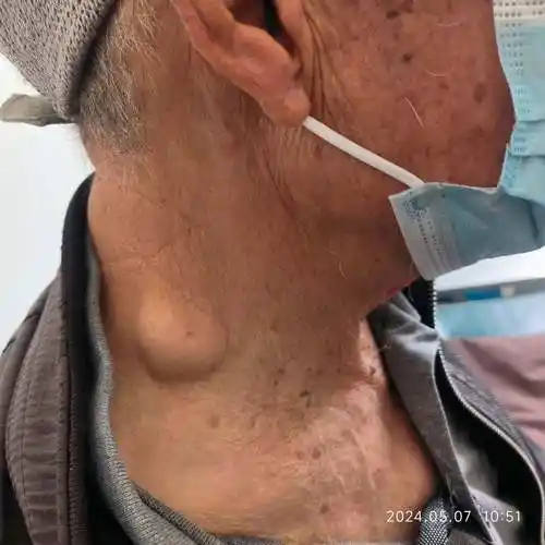 同一位置颈部脂肪瘤  是复发  还是没有切除干净  还是手术对周围脂肪