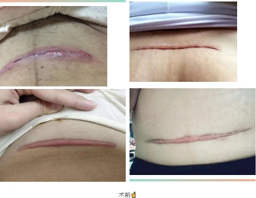 剖宫产美容缝合给妈妈一份真心的呵护