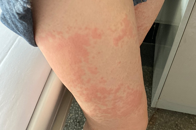 过敏性皮炎图片和症状