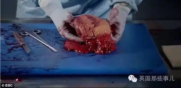 bbc记录片解剖108公斤重女尸,看完还有什么理由不!减!肥!