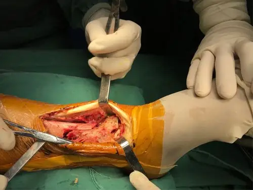 胫骨远端pillon骨折的手术治疗体会