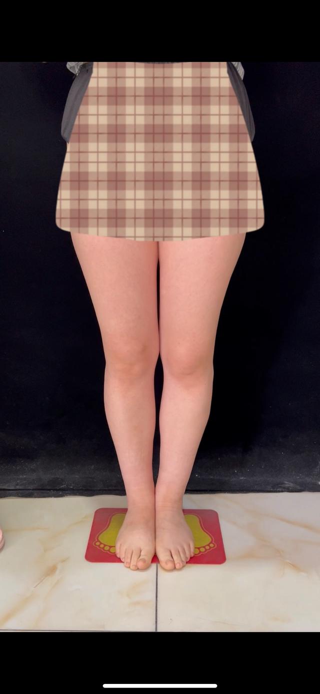 形体管理|直腿术能矫正o型腿或x型腿等不好看腿型吗?