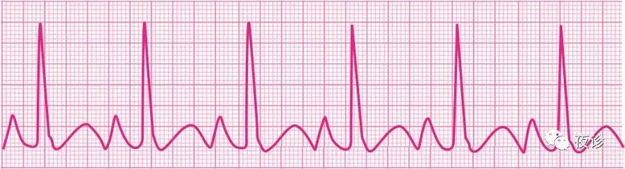 异常p波的心电图特点