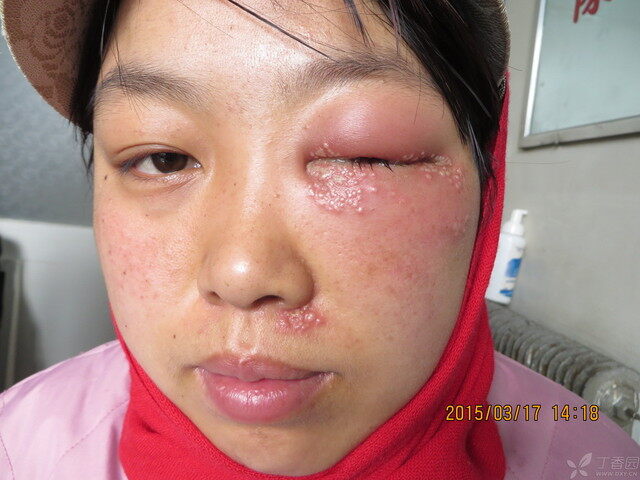 【请教】大家看看是带状疱疹还是单纯疱疹?