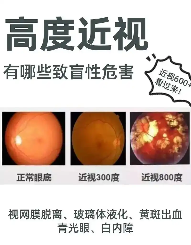 高度近视的危害,比你想象中更可怕!近视600度以上就是所谓 - 抖音