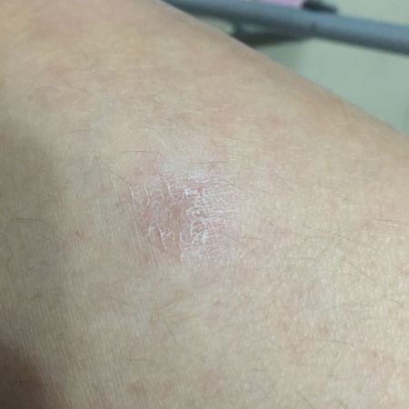 如图,不痛不痒,几个月前大腿外侧一个,最近小腿2个,想问问是皮肤干燥