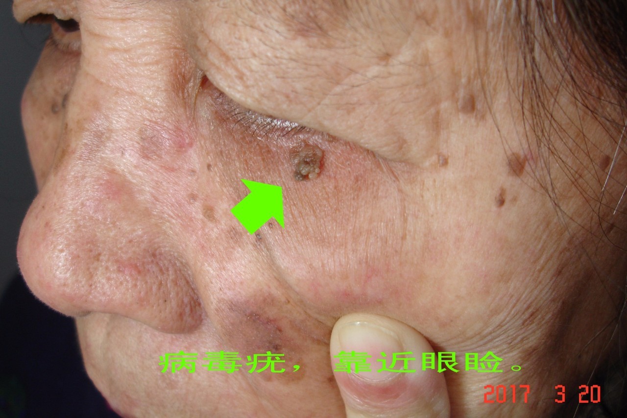 下眼皮疣冷冻一次治愈