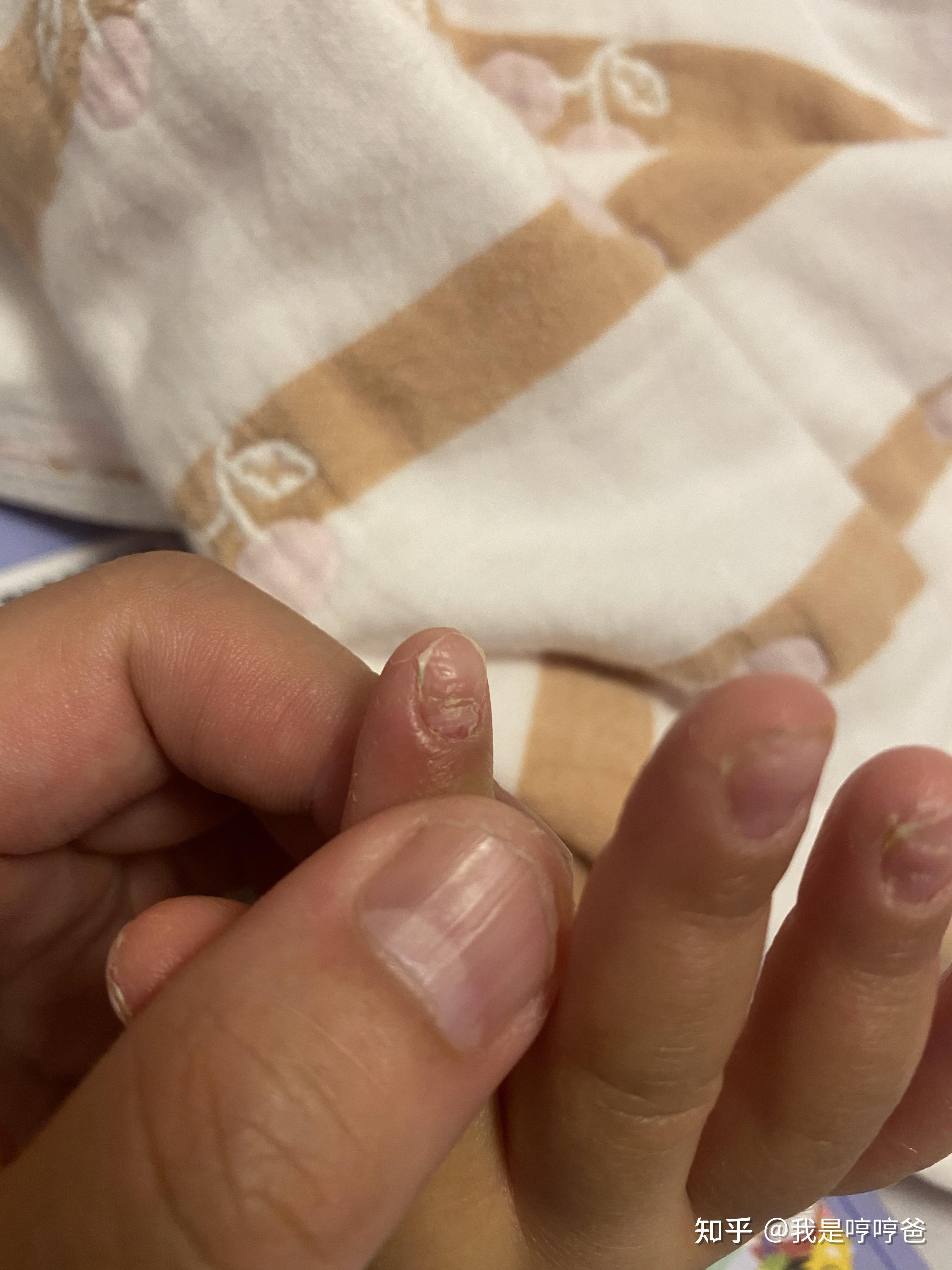 女儿指甲坑坑洼洼的不知道是什么问题?请教各位