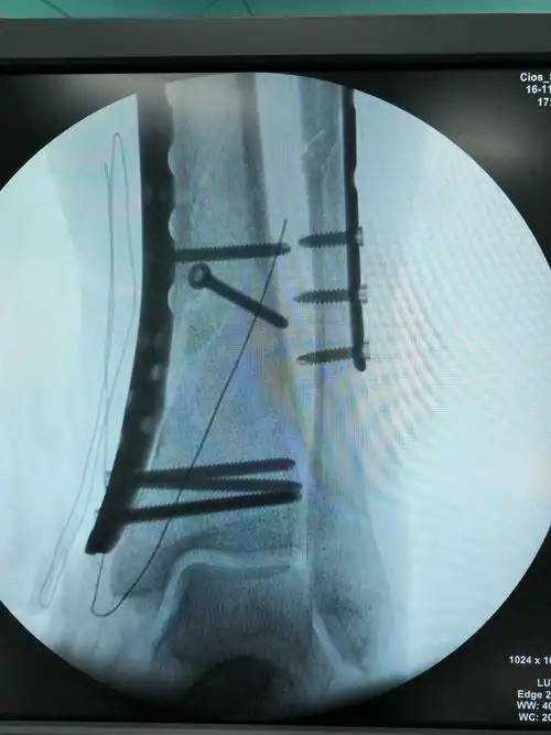 一例胫骨中下段骨折 pilon骨折桥接系统内固定