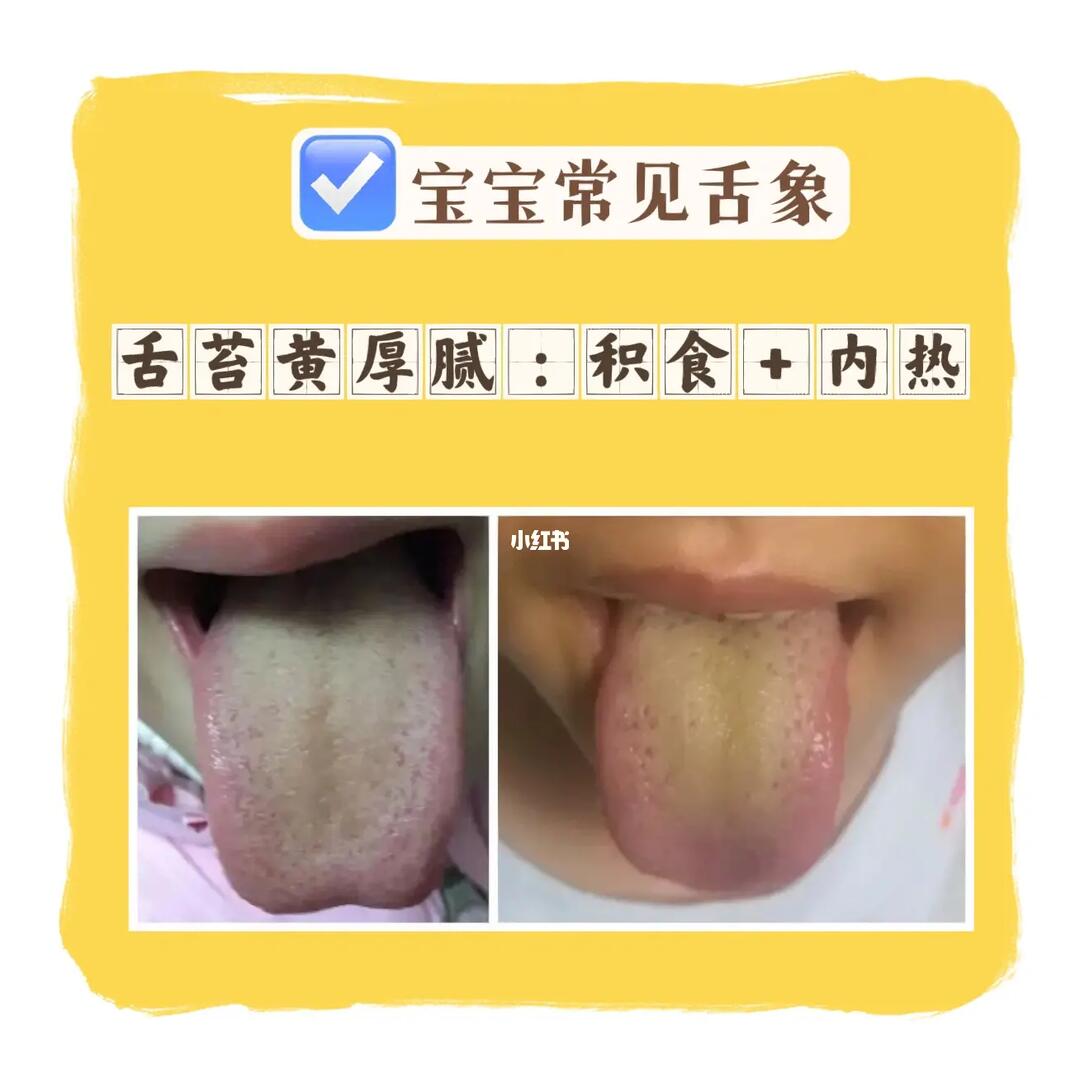 宝宝常见舌象2661590159015舌苔黄厚腻:积食 内热