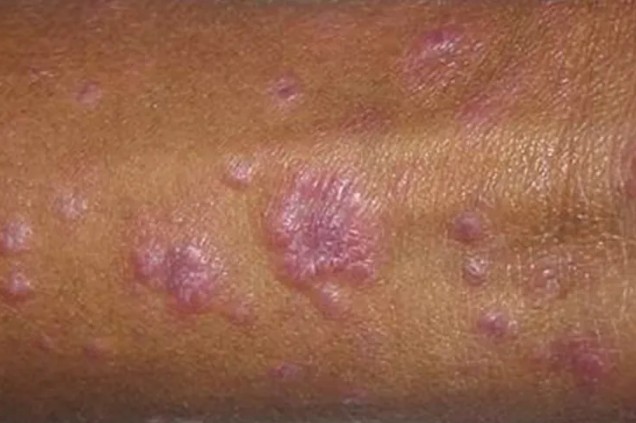 男梅毒初期图片40