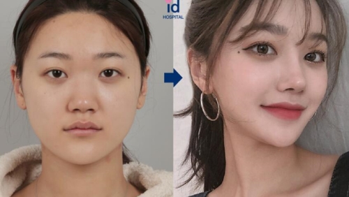 韩国id眼综合整形前后对比照片