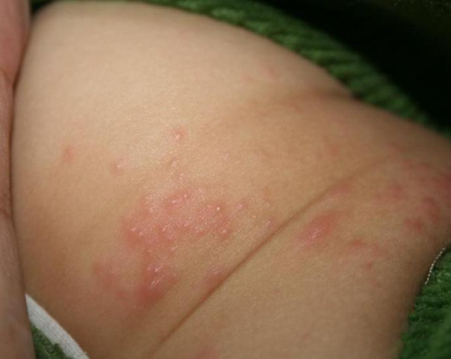 尿疹又称尿布皮炎,也就是妈妈们常说的宝宝"红屁股".