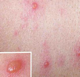 女性尖锐湿疣的症状图片,女性尖锐湿疣图片大全_女性尖锐湿疣_39疾病