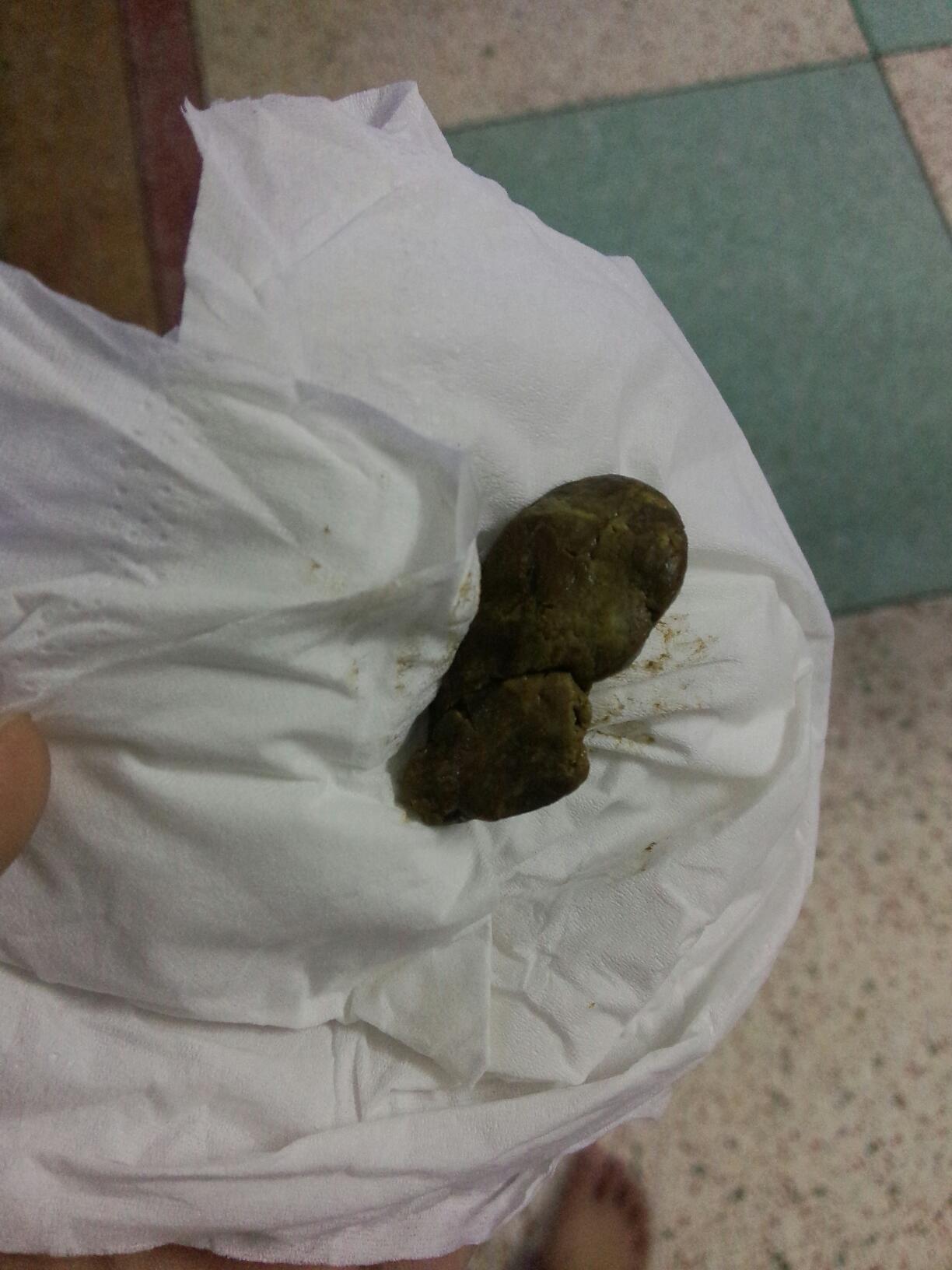 自从喂稀饭了就拉这样的屎,一天拉一粒,硬硬的,超臭,这样正常吗?