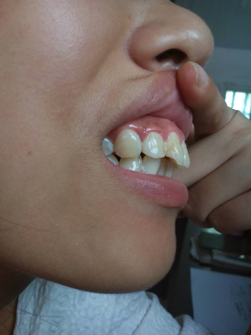 这是骨性龅牙吗?怎么矫正,大约花多少钱?