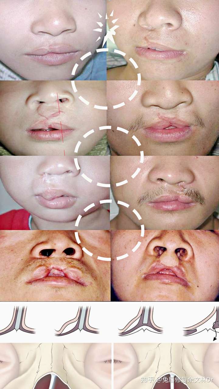 最轻微的唇隐裂图