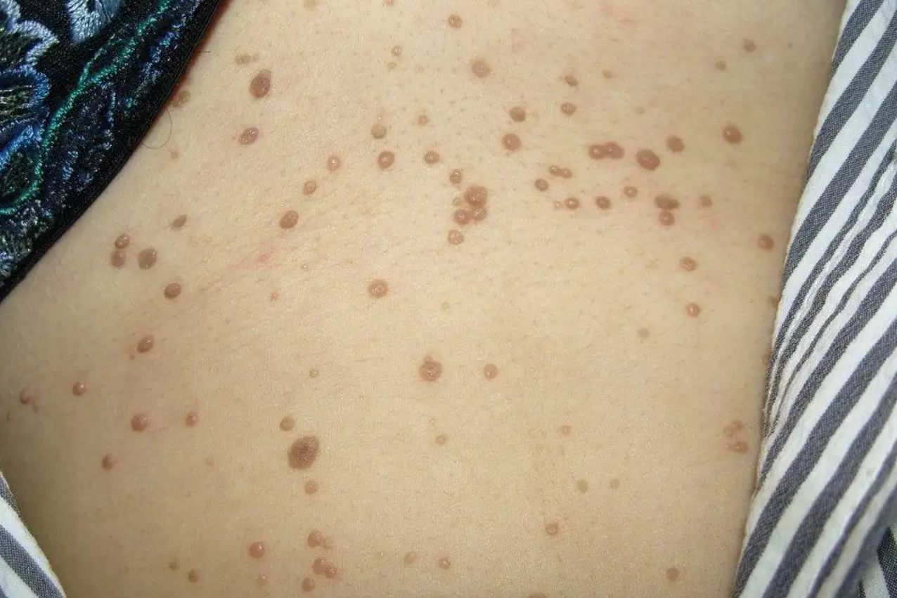 男性hpv真实图片初期