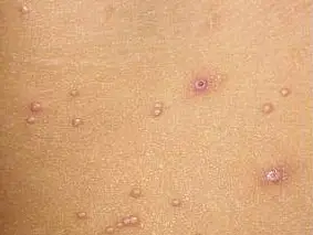 传染性软疣至于感染梅毒,淋病等性病的概率,其实极低极低.