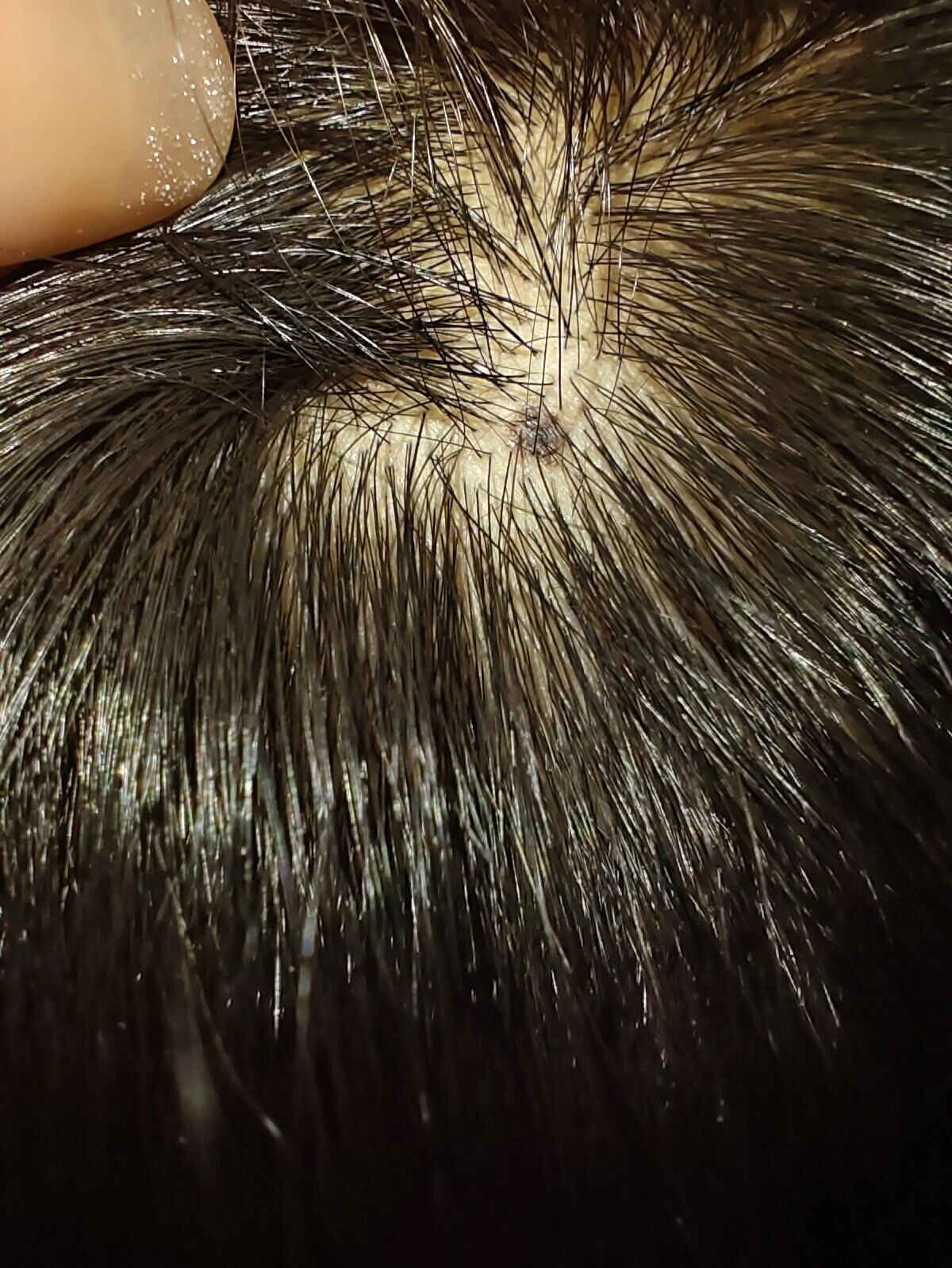 突然发现孩子头皮上长了颗黑痣   有懂得吗 这痣有问题吗