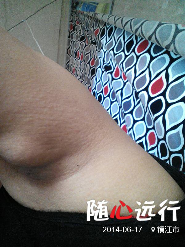 长了个像瘤的东西的,这是什黱呢 1 2010-02-19 为什黱怀孕后腋下变黑