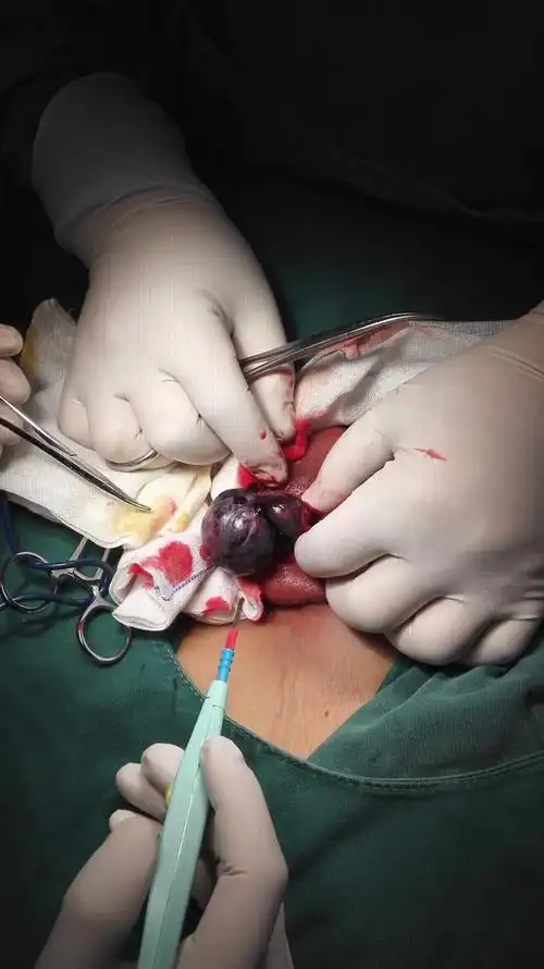 科普:睾丸扭转14岁少年骑单车碰到"蛋蛋"因羞涩延误就诊,导致一侧睾丸