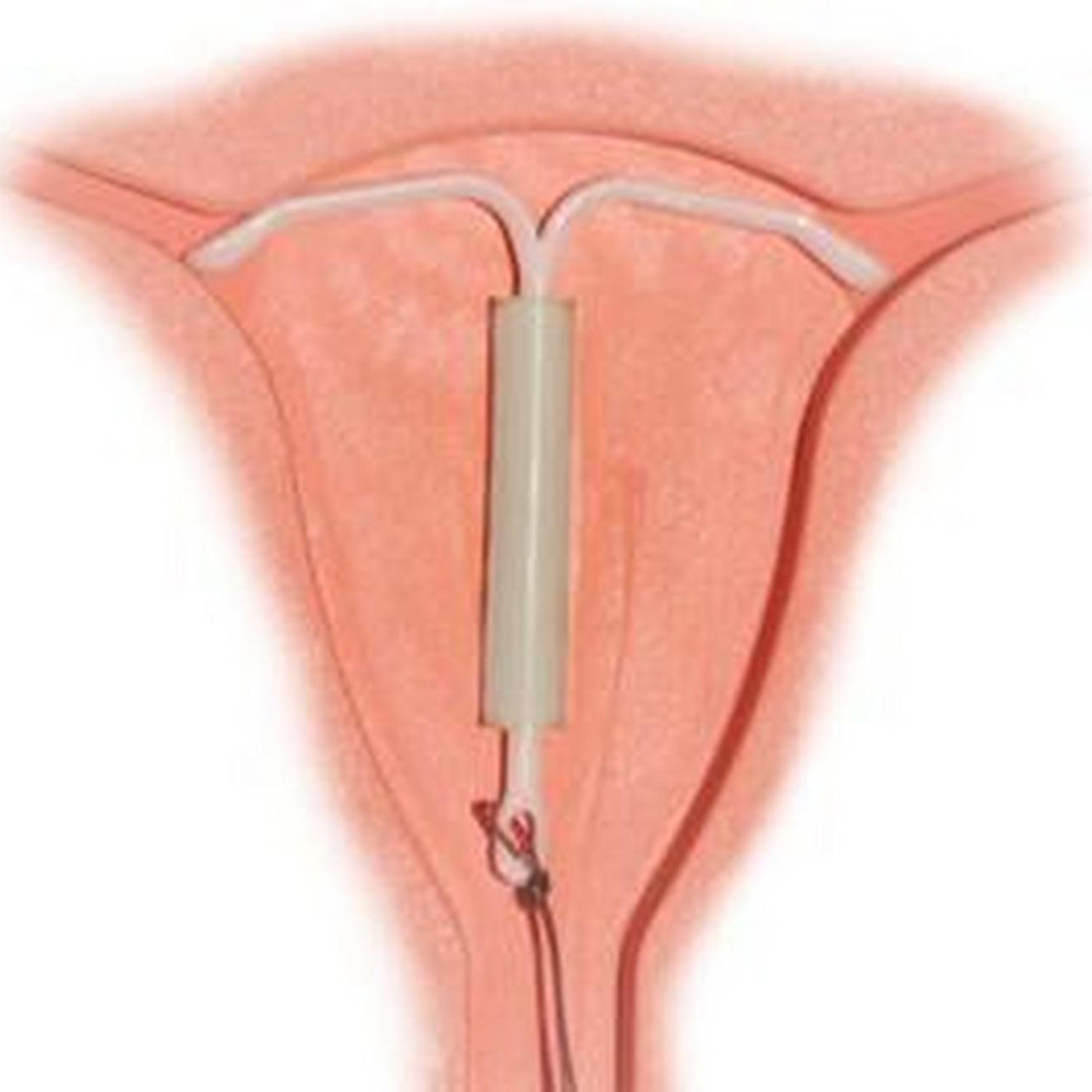 上曼月乐环前,这三点应该先了解#腺肌症#  得了腺肌症的姐妹都想上