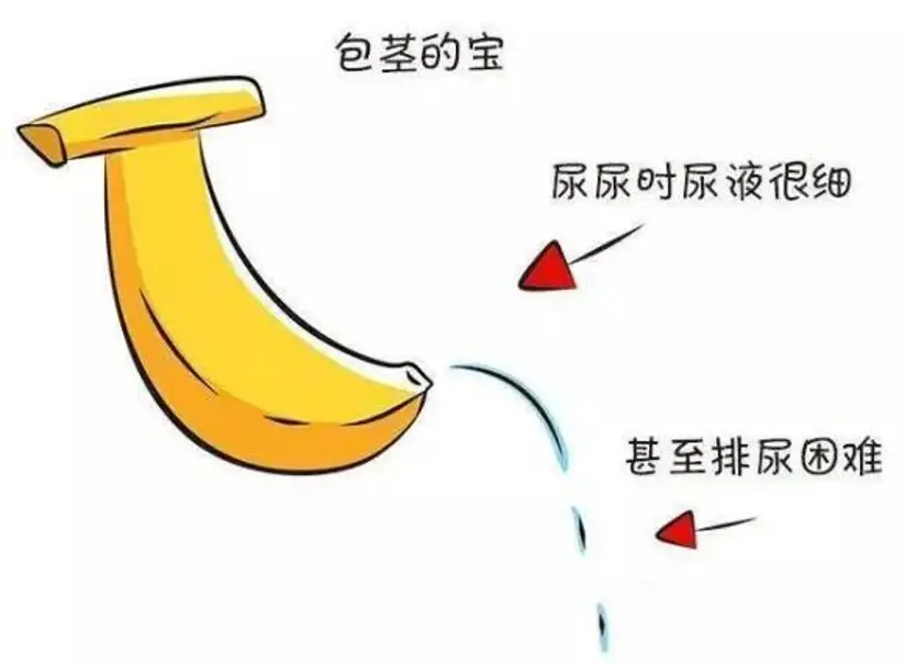 74 包茎是包皮口狭窄,使包皮不能翻转显露阴茎头,排尿时尿流细如线