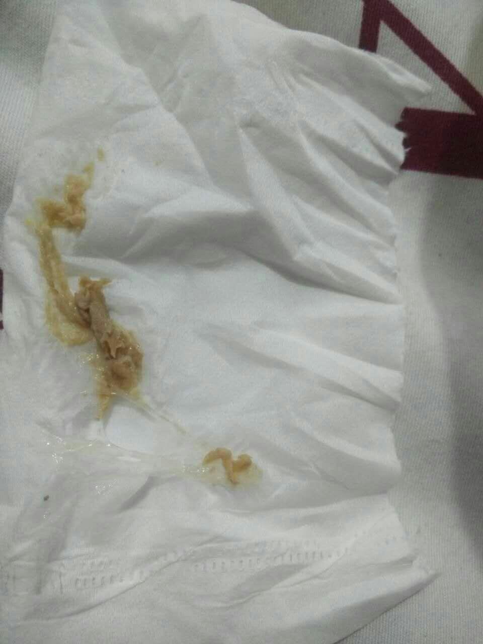 我是宫颈糜烂,看排出的毒素是不是很恶心