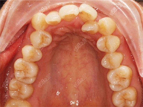 杭州格莱美口腔隐形矫正攻略,想说整完牙变化大,价格还不贵,牙齿矫正