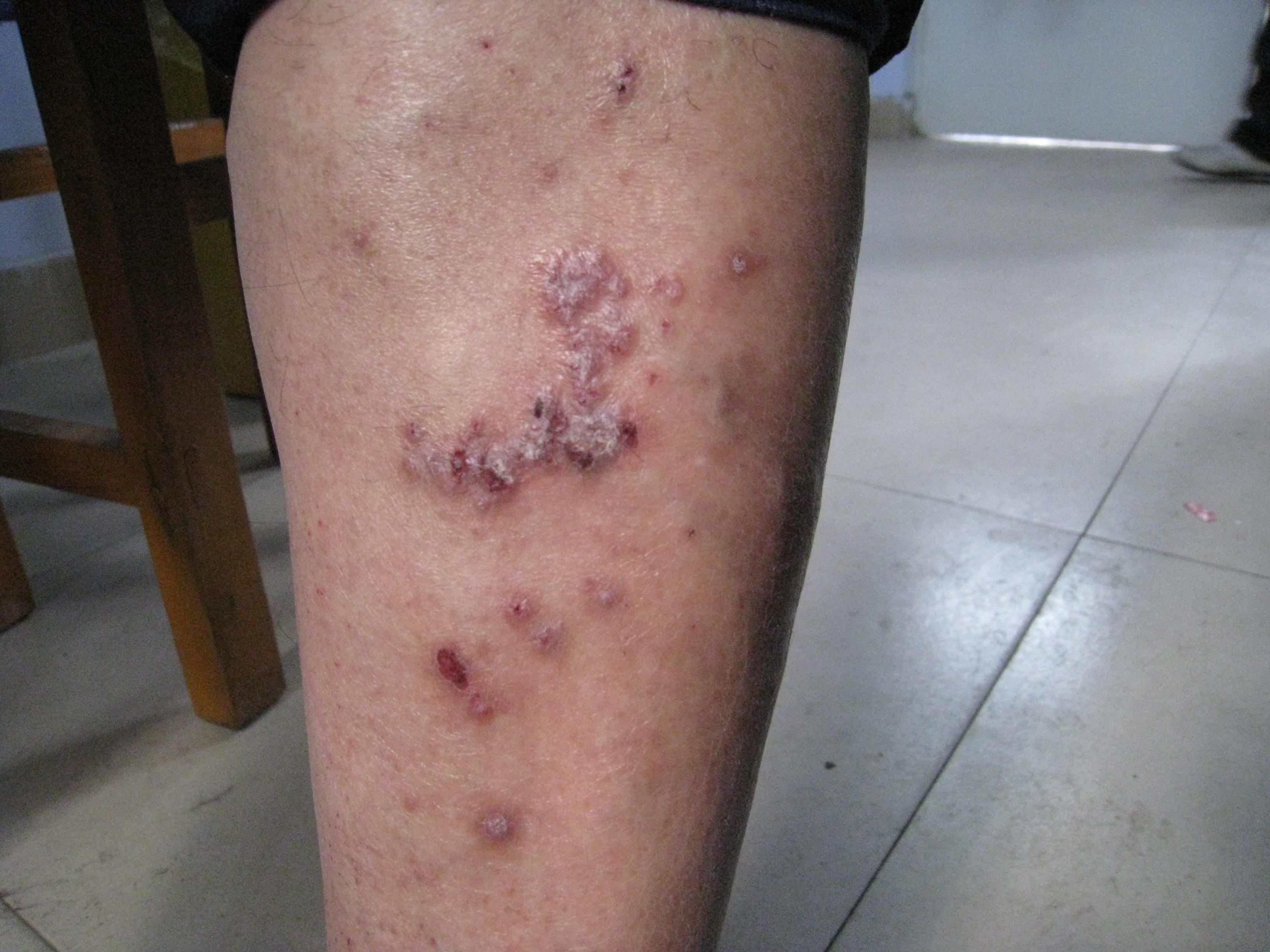 封闭治疗结节性痒疹效果好