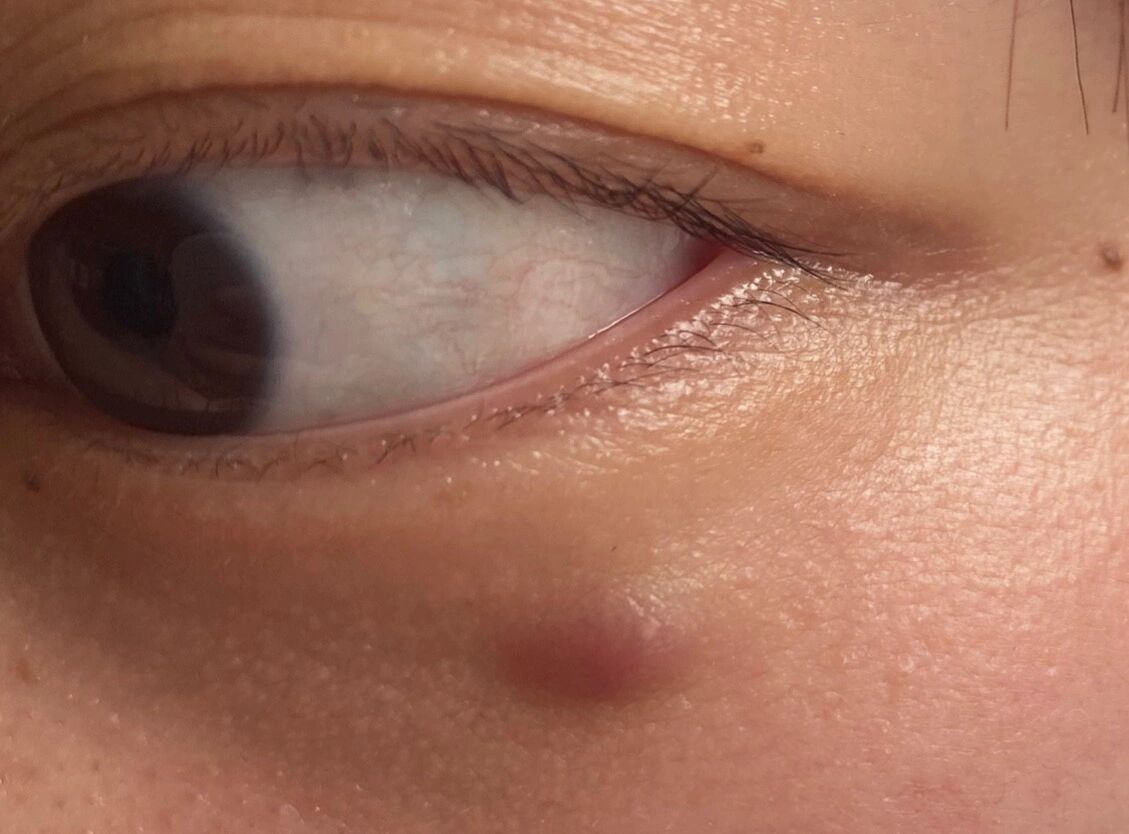 去市中医院说是皮脂腺囊肿 激光去除,不做去不了 考虑到眼睛下边且会