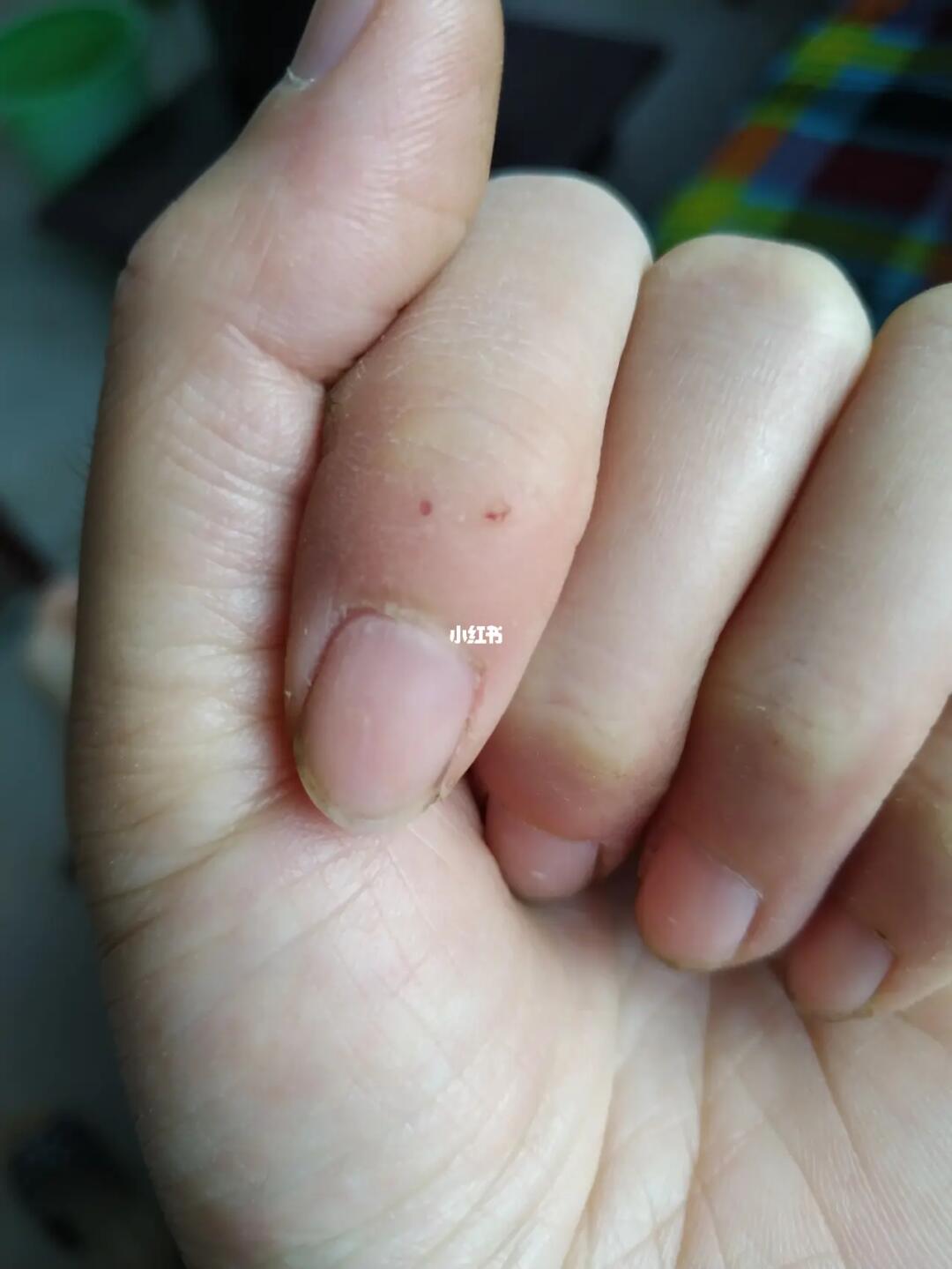 被自家的小猫咪咬成这样有必要去打针吗