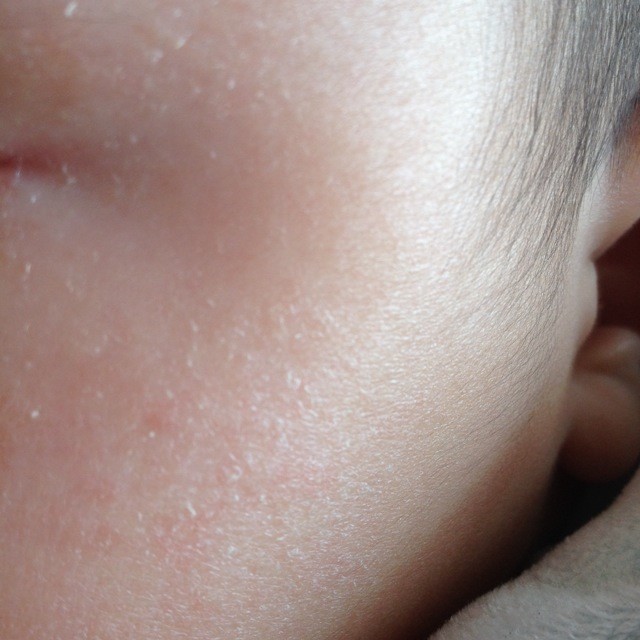 非常着急:宝三个多月,身上多处皮肤一片片(两枚硬币面积大小)白色的摸